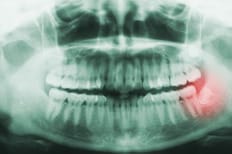 Impacted wisdom teeth are a common cause of TMJ pain