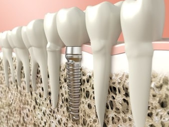 Dental implants can be a key part of TMJ treatment